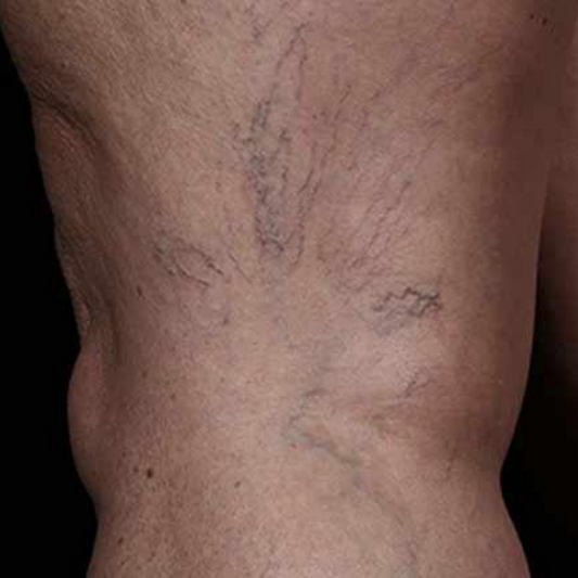 Laser Vascular Treatment