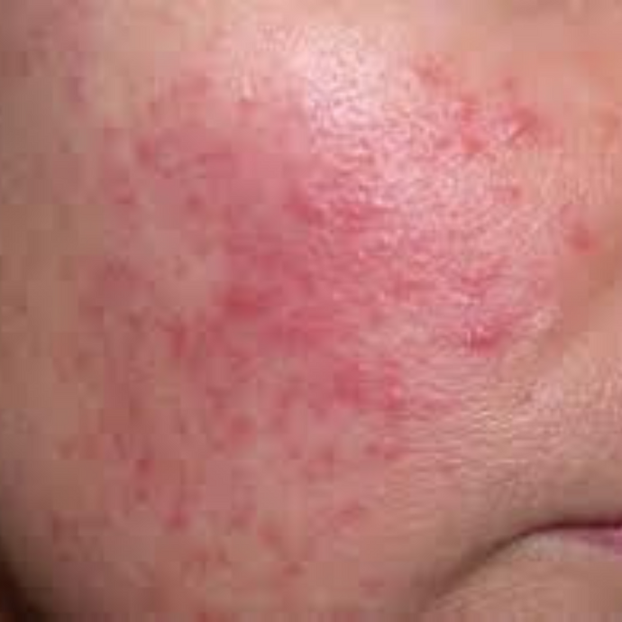 Rosacea Skin Consultation