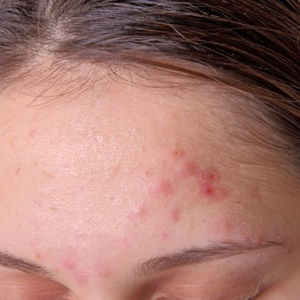Acne Skin Consultation
