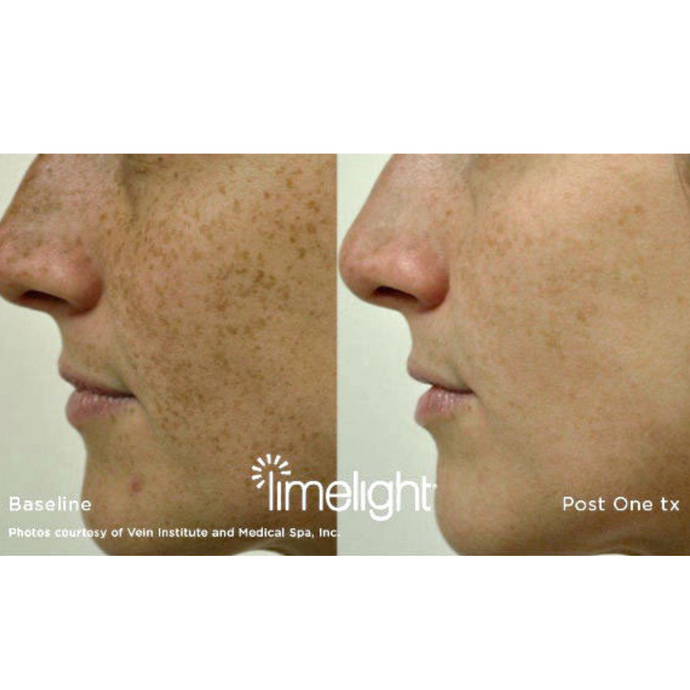 Pigmentation Skin Consultation